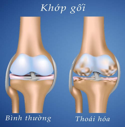 Thoái hóa khớp gối: Nguyên nhân, triệu chứng, chẩn đoán và điều trị